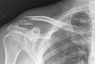 broken shoulder