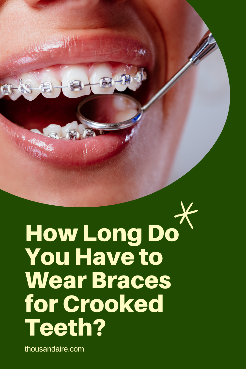 How Long Do You Have to Wear Braces for Crooked Teeth